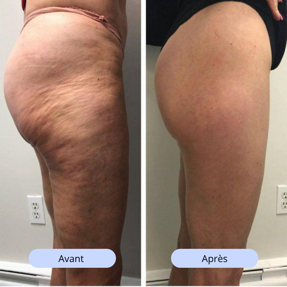 Ventouse Anti-Cellulite Cellune™